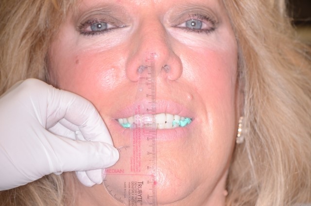 Partial Dentures For Back 
      Teeth Athens IL 62613